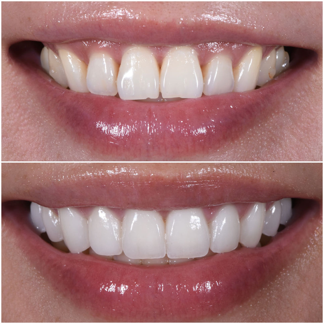 Cosmetic Dentistry Veneers: Everything for a Natural-Looking Smile