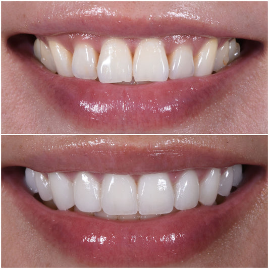 Cosmetic Dentistry Veneers: Everything for a Natural-Looking Smile